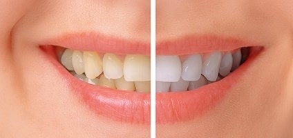 Tænder før og efter en tandblegning