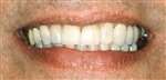 Tandsæt efter der er indsat tandkrone