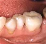 Tænder med tandkrone