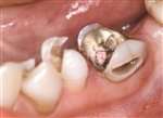Tænder med metalfyldning